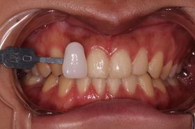 After treatment, case 4