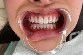 After treatment, case 5