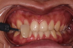 Before treatment, case 4