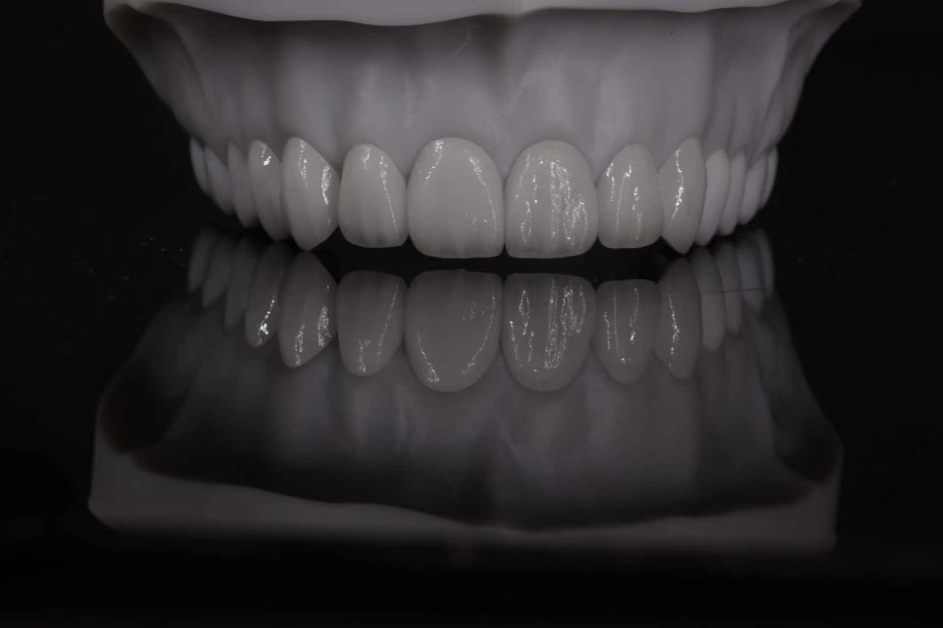 Premium CAD/CAM glass ceramic anterior restoration case 1