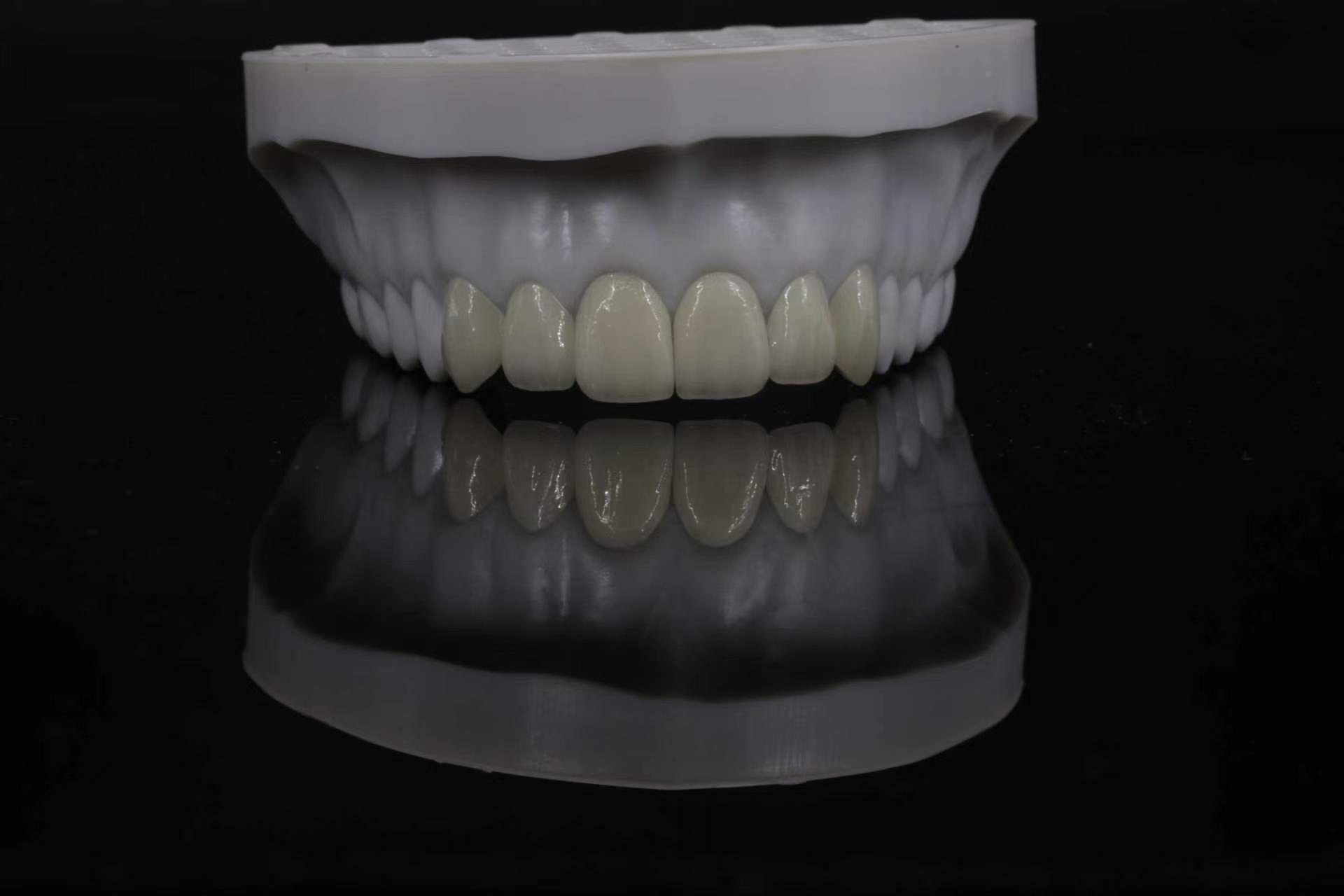 Premium CAD/CAM glass ceramic anterior restoration case 2