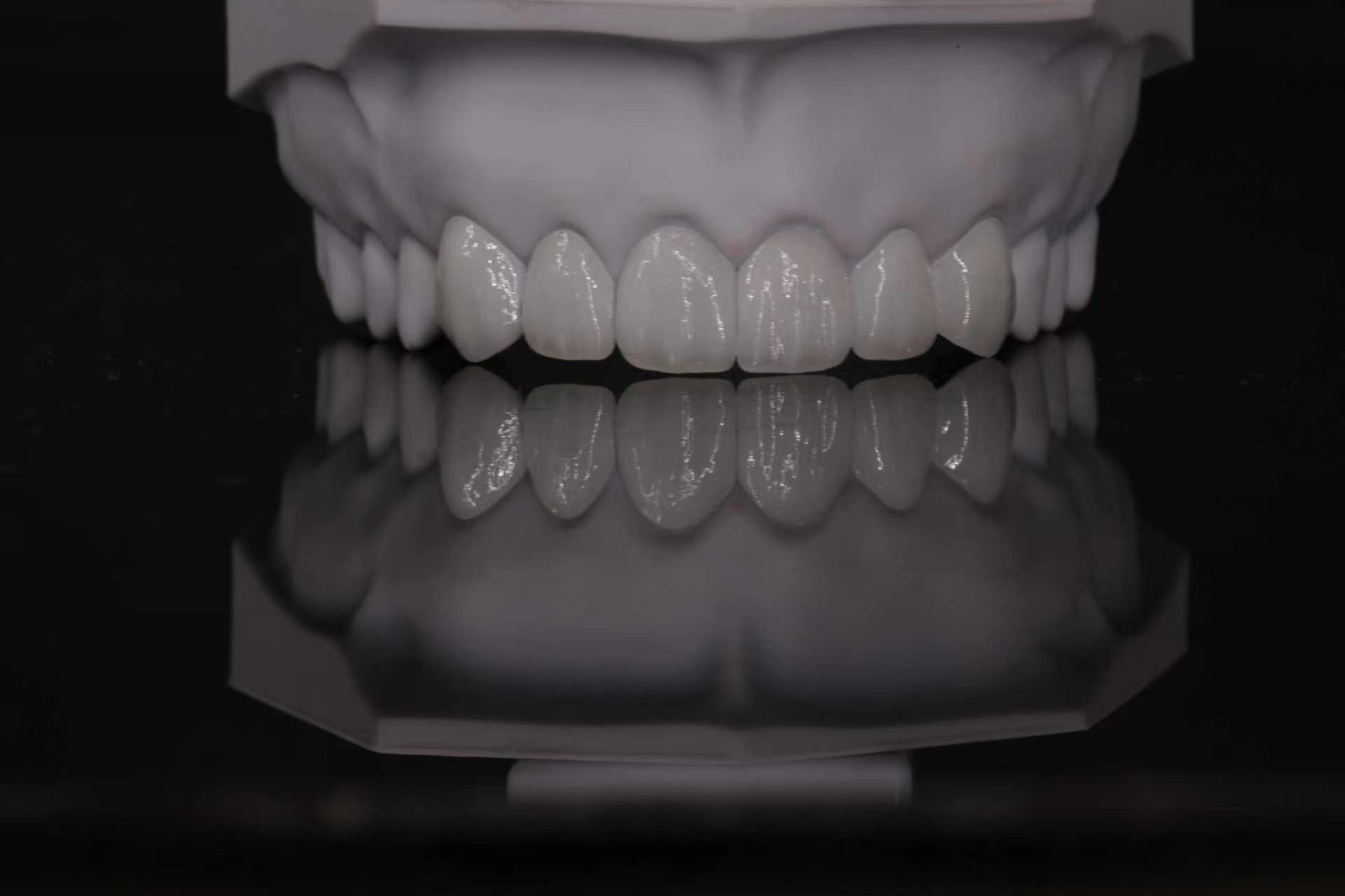Premium CAD/CAM glass ceramic anterior restoration case 3