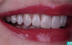 Clinical cases of Prosthodorntics