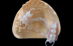 Removables Denture