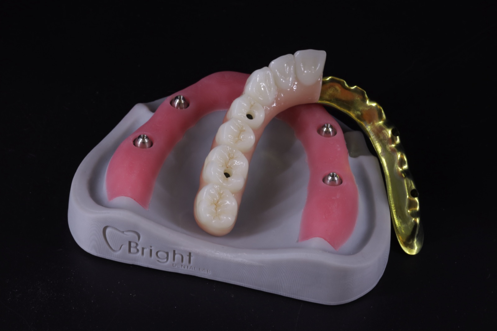 Bar-retained implant overdenture with locator attachments on model