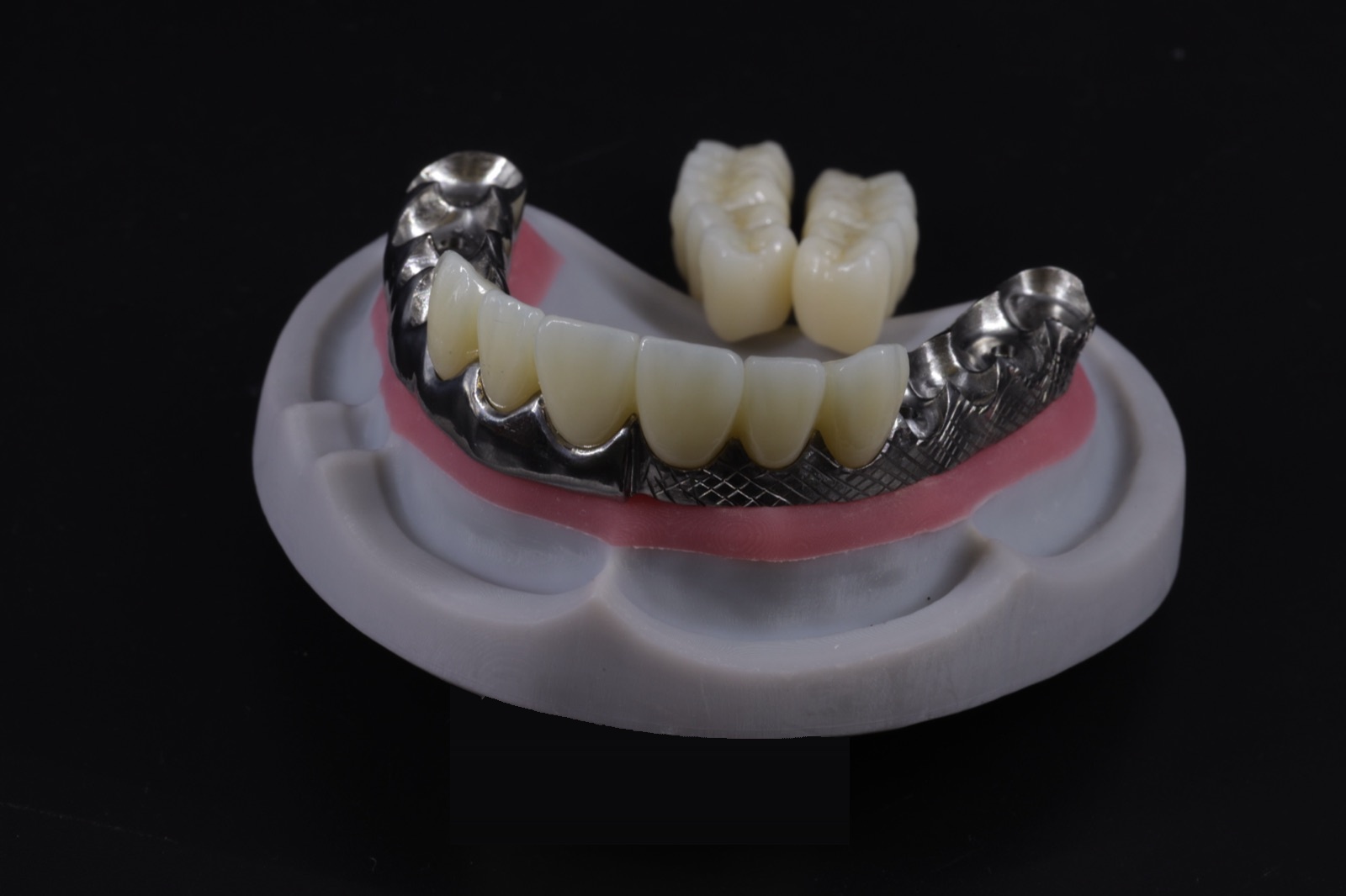 Milled metal framework for implant-supported fixed bridge